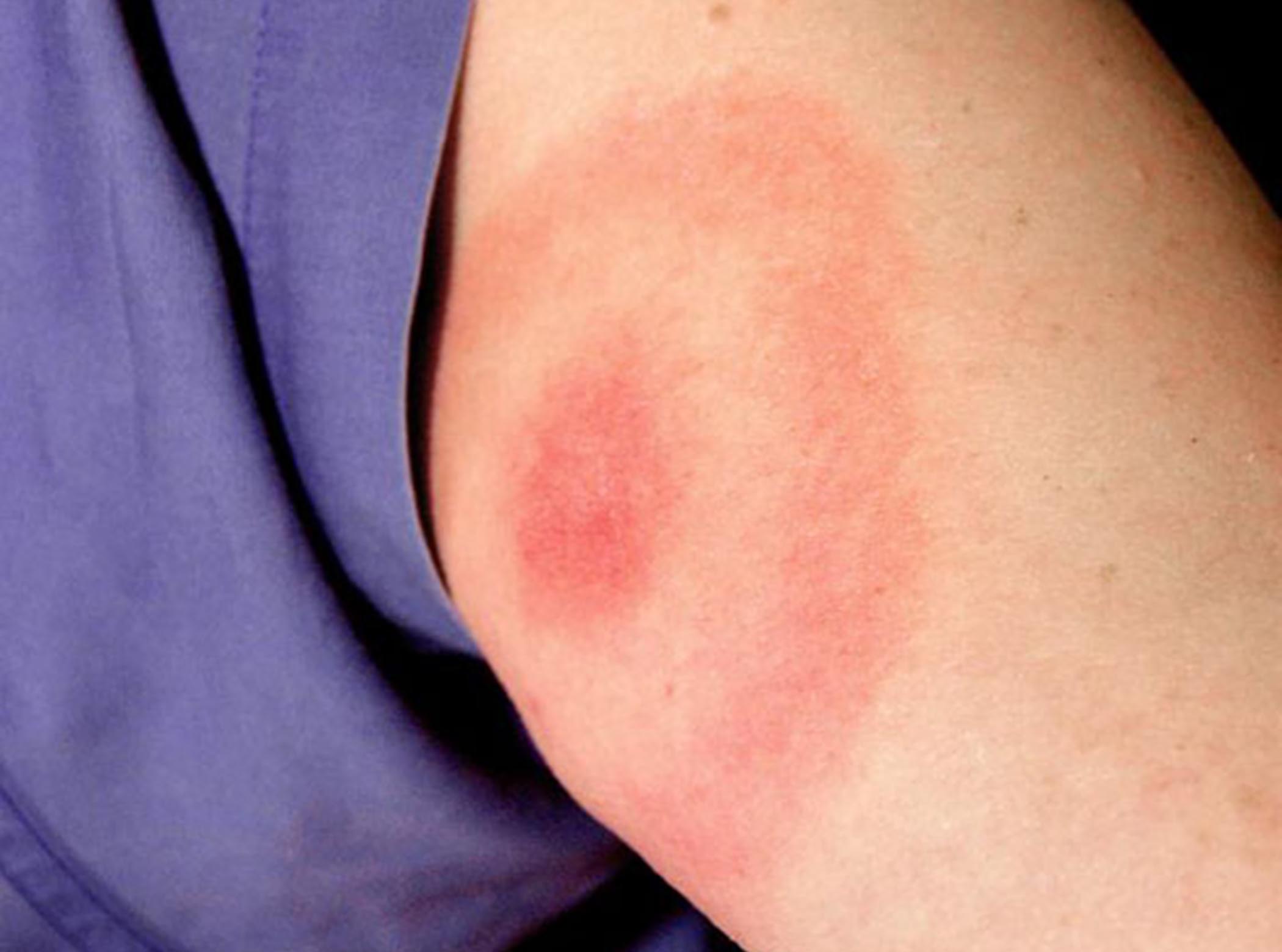 Lyme vaccine trial enrolling participants for phase three